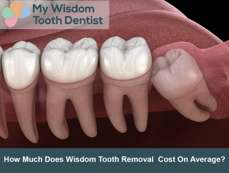 How Much Does Wisdom Tooth Removal Cost On Average
