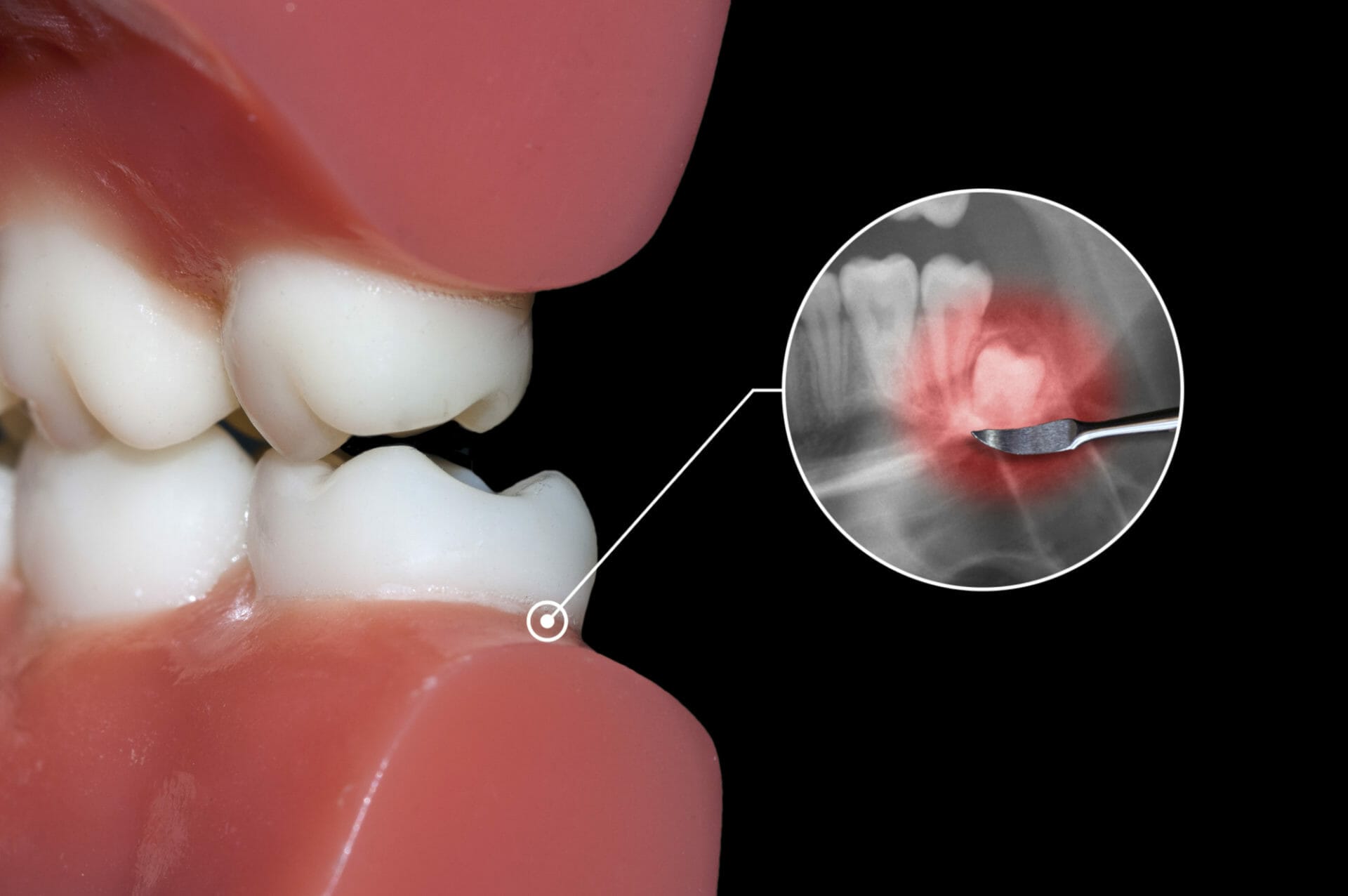 Best wisdom tooth removal in South Perth
