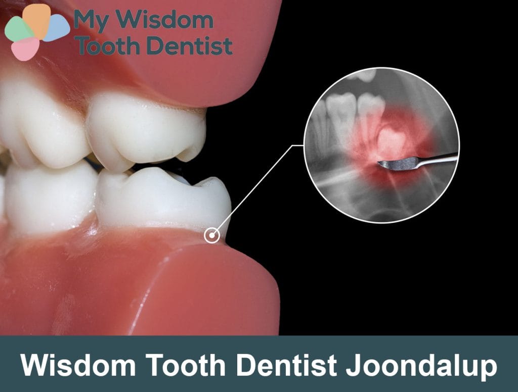 Cheap Wisdom teeth dentist in Joondalup