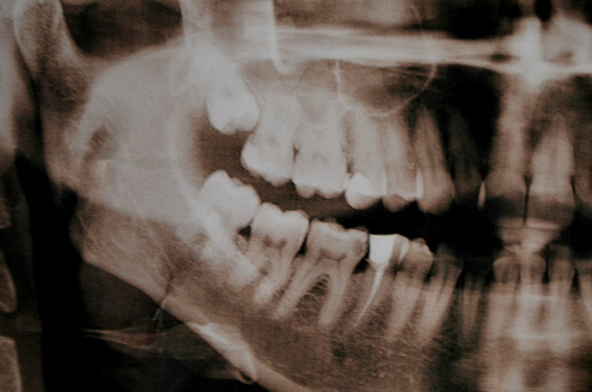 perth wisdom teeth removal